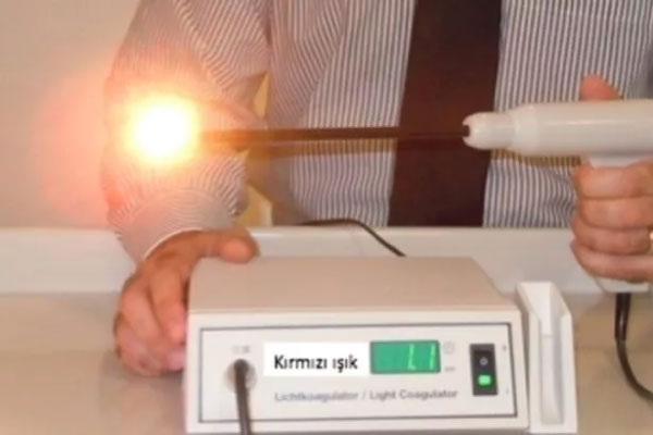 İnfared-Koagülatör